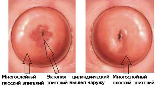 эктопия шейки матки