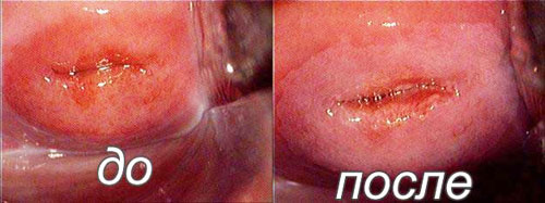 шейка матки до и после обработки солковагином