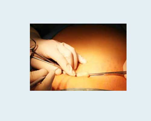 Папилломавирусную инфекцию фото у женщин лечение народными средствами фото thumbnail