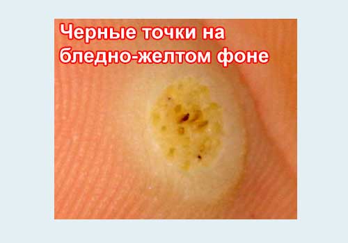Что такое инфекционная подошвенная бородавка thumbnail