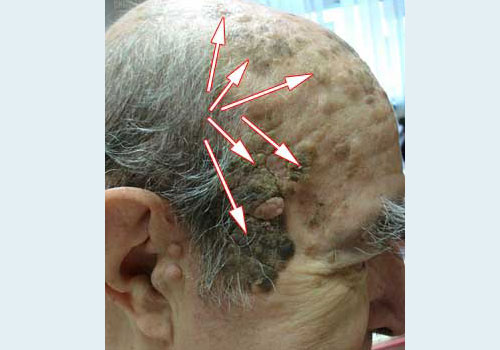 Лечение старческих бородавок возрастные кератомы thumbnail