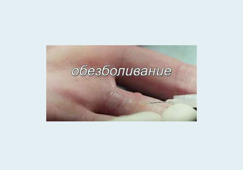 Удаление бородавок на руках лазером видео thumbnail